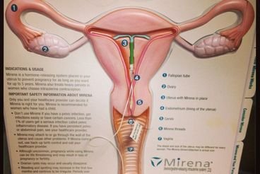 Преимущества спирали Мирена